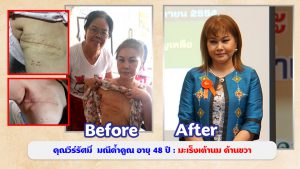 คุณวีร์รัศมิ์ มณีค้ำคูณ อายุ 48 ปี : มะเร็งเต้านม ด้านขวา